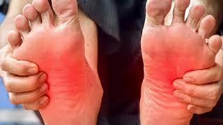 ERITROMELALGIA Dolor y ardor en los pies  pies calientes DOLOR DE PIES