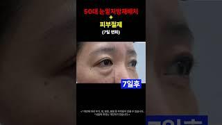 50대 눈밑 피부 늘어짐 지방주머니 7일변화 눈밑지방재배치 눈밑피부절제 중년눈수술 #modsclinic #모즈클리닉 #눈밑지방 #눈밑지방재배치