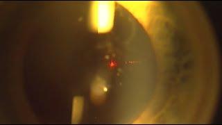 YAG LASER Capsulotomy for Post Cataract Posterior Capsular Fibrosis