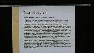 Eliminating Shoulder Pain (2/11)