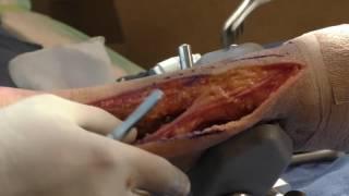 Acumed Ankle Plating System 3 Cadaver Lab Part 3 Proximal Posterolateral Approach