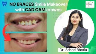 NO BRACES Smile Makeover With CAD CAM Zirconia Crowns: Dr. Srishti Bhatia #smilemakeover