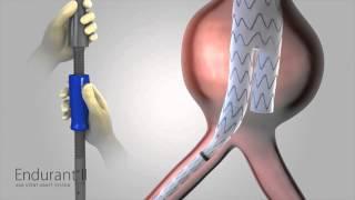 Abdominal Aortic Graft - Medical Animation by Watermark