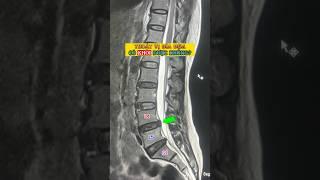 Thoát vị đĩa đệm có khỏi được không? Cùng xem video để biết câu trả lời nhé
