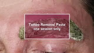 Eyebrow Tattoo Removal Procedure