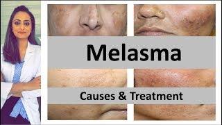 How to treat dark spots | Melasma | Causes & treatment | Dermatologist | Dr. Aanchal Panth