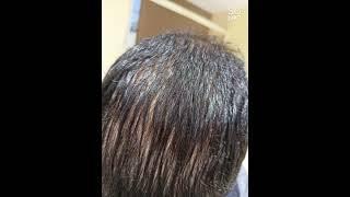 Medispa  failed hair transplant