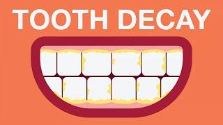 What causes tooth decay?