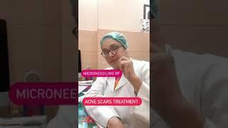 Acne scars treatment | Dr Ashima Goel | Dermatologist |Chandigarh| Mohali |Punjab #shorts