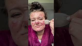 Best Pimple Patch Removals
