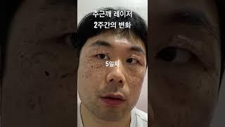 주근깨 레이저 2주간의 변화 #주근깨 #레이저