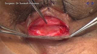 Entropion Correction (Lower Eyelid) - Jones Procedure