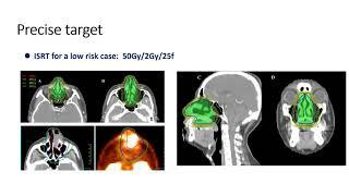 Dr. Shunan Qi: NK/T-Cell Lymphoma