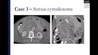 Solid and cystic pancreatic lesion