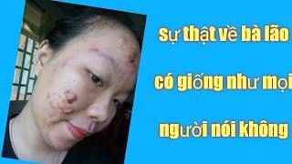 Trị mụn bà lão - sử dụng sản phẩm bà lão không như mọi người nói