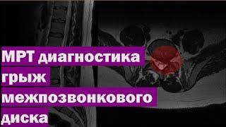 МРТ диагностика грыж межпозвонкового диска | Как выглядит грыжа на МРТ