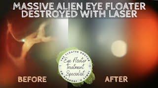 Huge Alien Eye Floater Destroyed with Laser. YAG Laser Vitreolysis Specialist