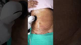 Abdomen Liposuction result | RF Session #shorts