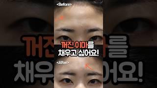 꺼진 이마, 울퉁불퉁한 이마가 컴플렉스인 분들 주목!‍️자연스럽게 채우는 이마필러