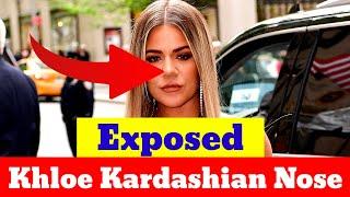 Khloe Kardashian Exposes Her ‘Collapsed’ Nose | Celebrities News Today | Hollywood News Today