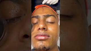 #male #skintreatment #skincare #chennai #bangalore #skincareroutine #bestplace #shorts #trend 