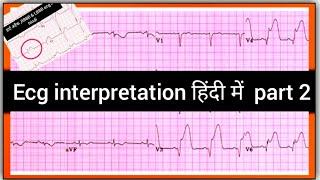 Ecg interpretation part 2 in hindi #easyecgreading // हार्ट अटैक ,RBBB & LBBB ecg in hindi