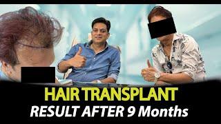 Hair Transplant Results After 9 Months | Real Patient Review | Rejuvena Cosmo Care Jaipur |