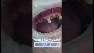 Новые зубы за 2 часа. New teeth in 2 hours.