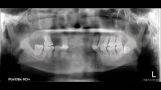 Immediate implant placement using Biotem implants