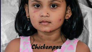What You Need to Know About Chickenpox: Symptoms, Stages, and Prevention