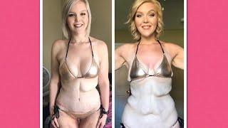 1 month post BA and Tummy Tuck 560ccs