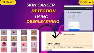 Skin Cancer Detection using Deep Learning | Machine learning | Best IEEE Machine Learning Project