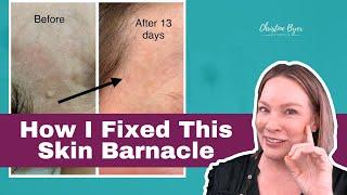 Shocking Cause of Pigmentation/ Barnacles & How I Fixed It! 