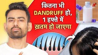 Dandruff का Permanent Solution at Home (For Men & Women)