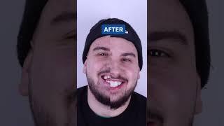 Dental Work in Turkey Transformation | Turkey Teeth Before & After