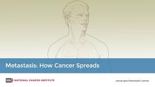 Metastasis: How Cancer Spreads