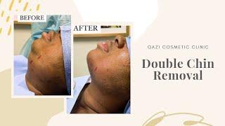 Double Chin Removal by Dr. Nadir Qazi