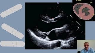 Live: Tips & mistakes in PLAX measurements