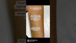 Hesitation cut marks laser treatment #lasertreatment