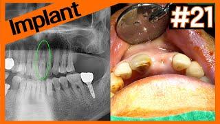 [Online Surgery] 2 stage implant on #21 after socket preservation using A-Oss Collagen