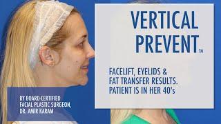 San Diego Fat Transfer, Under Eye (Blepharoplasty), and Facelift