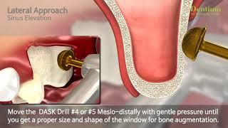 DASK - Total Solution for Sinus Lateral approach