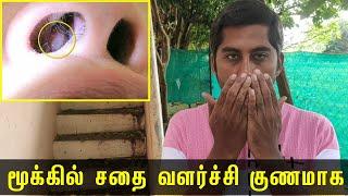 மூக்கில் சதை வளர்ச்சியா? வீட்டிலேயே தீர்வு இதோ! | Next Day 360