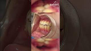 Открытый прикус  #orthodontist #зубы#брекеты #стоматология