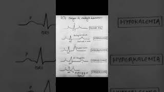 ECG changes