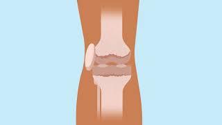 How knee replacement surgery is carried out | Bupa Health