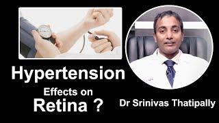 Hypertension effects on Retina I Dr Srinivas Thatipally I Doctors Inside