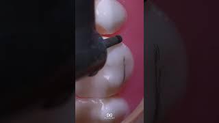 Step-by-Step molar crown prep. #dentistry #dentaleducation #MolarPrep