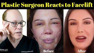 Plastic Surgeon Reacts | Lorry Hill's Facelift Before & After