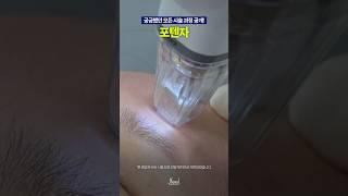 포텐자 시술과정 대공개